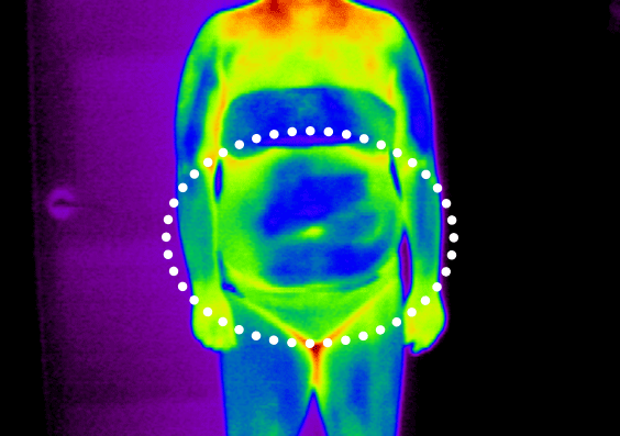 셀룰라이트 4단계