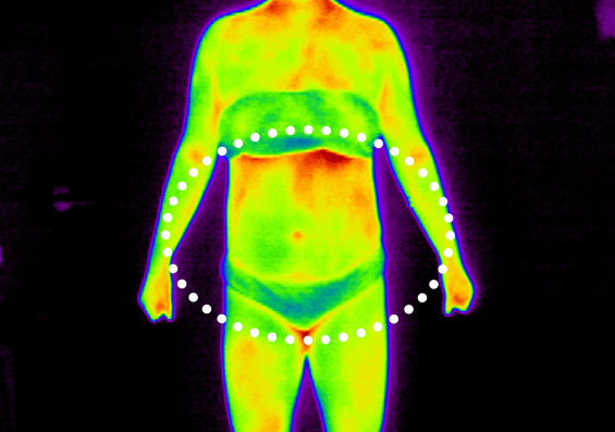 셀룰라이트 2단계