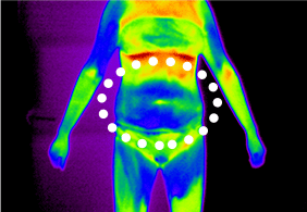 셀룰라이트 4단계