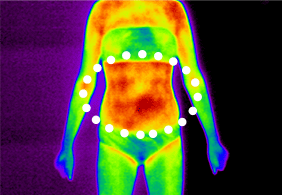 셀룰라이트 2단계
