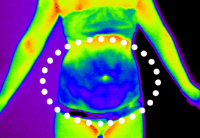 셀룰라이트 4단계