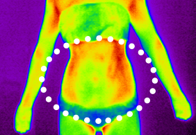 셀룰라이트 2단계