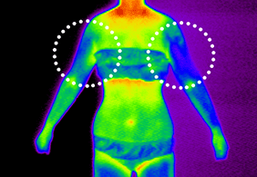 셀룰라이트 2단계