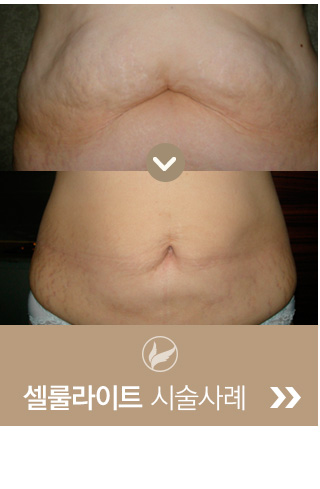 셀룰라이트 시술 사례 - 전후 사진