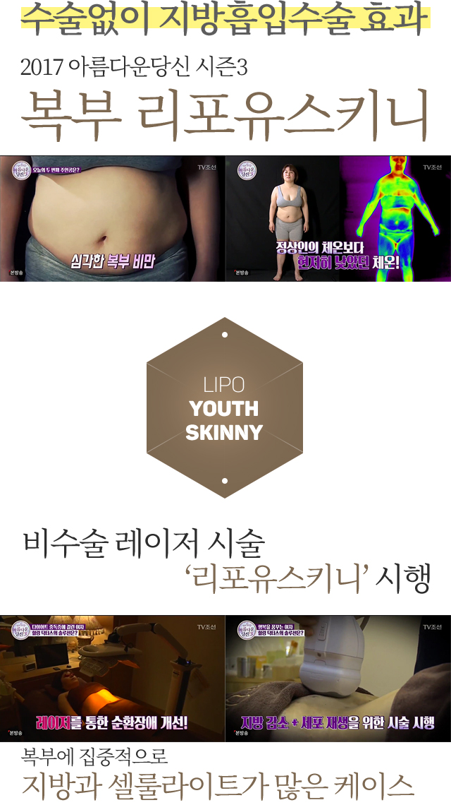 수술 없이 지방흡입수술 효과. 2017 아름다운 당신 시즌 3. 복부 리포유스키니. 비수술 레이저 시술 ‘리포유스키니’ 시행. 복부에 집중적으로 지방과 셀룰라이트가 많은 케이스.