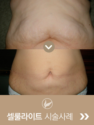 셀룰라이트 시술 사례