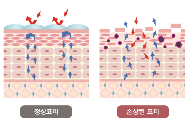 정상 표피와 손상된 표피