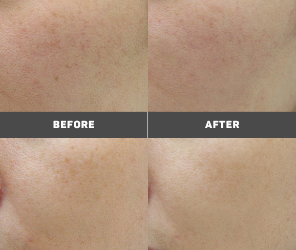 모공 전후 사진