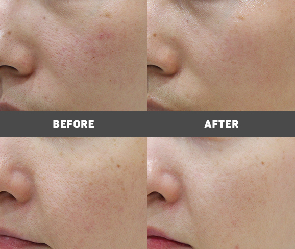 모공 전후 사진