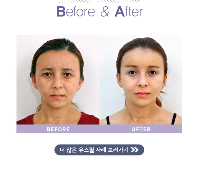 유스필 전후 사진