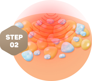 다이나믹 지방파괴술