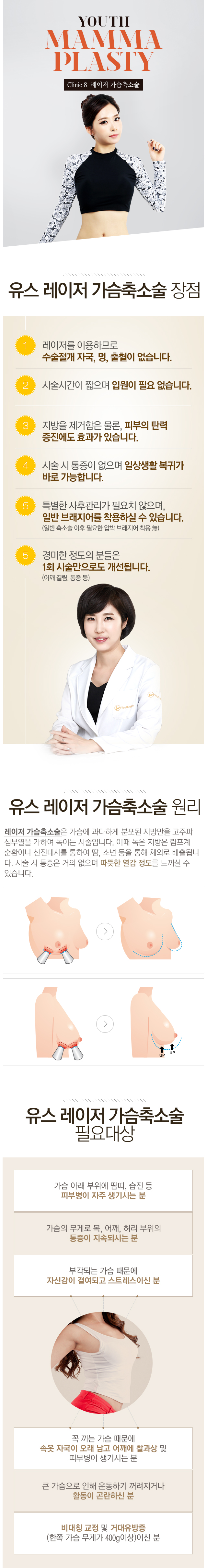 레이저 가슴 축소술 장점, 원리, 필요 대상