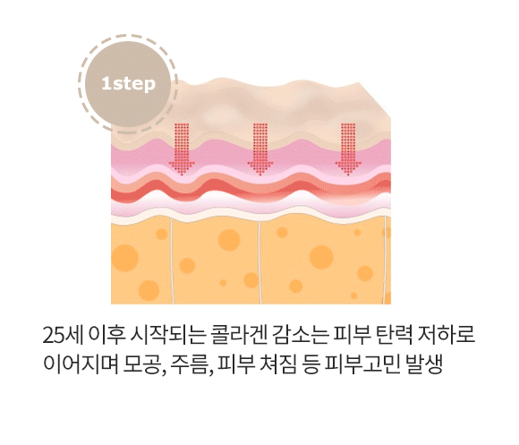 비수술 안면거상술, 울쎄라토스! 3단계