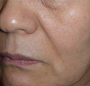 리프팅 시술 전