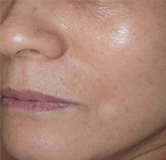 리프팅 시술 후