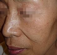 리프팅 시술 전