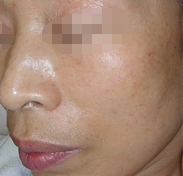 리프팅 시술 후