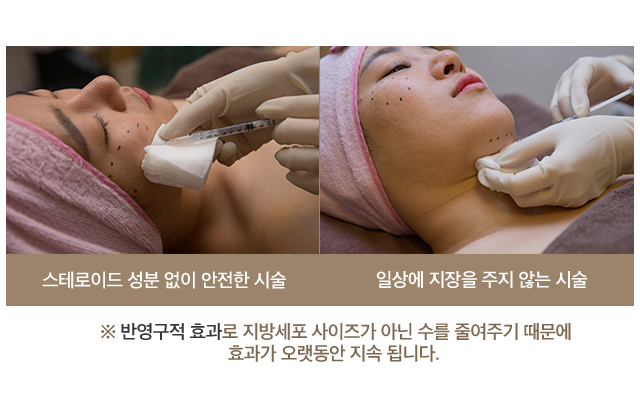 스테로이드 성분 없이 안전한 시술, 일상에 지장을 주지 않는 시술
