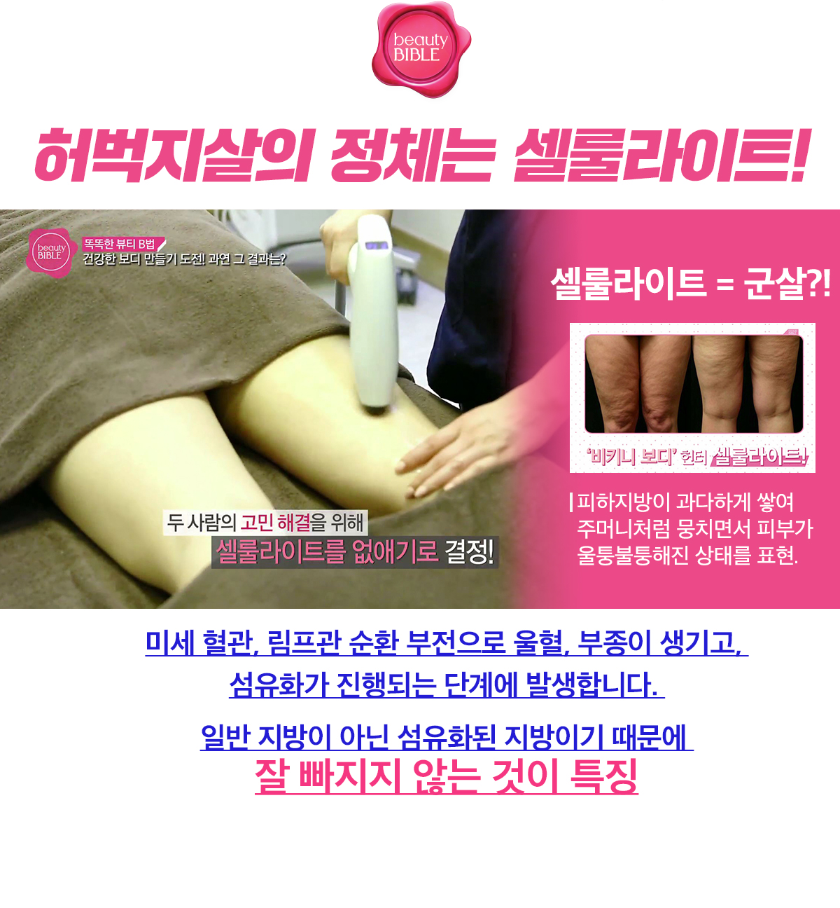 허벅지살의 정체는 셀룰라이트!