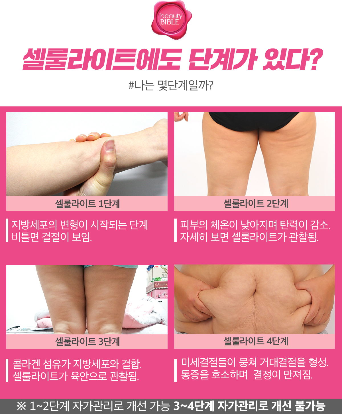 셀룰라이트에도 단계가 있다?