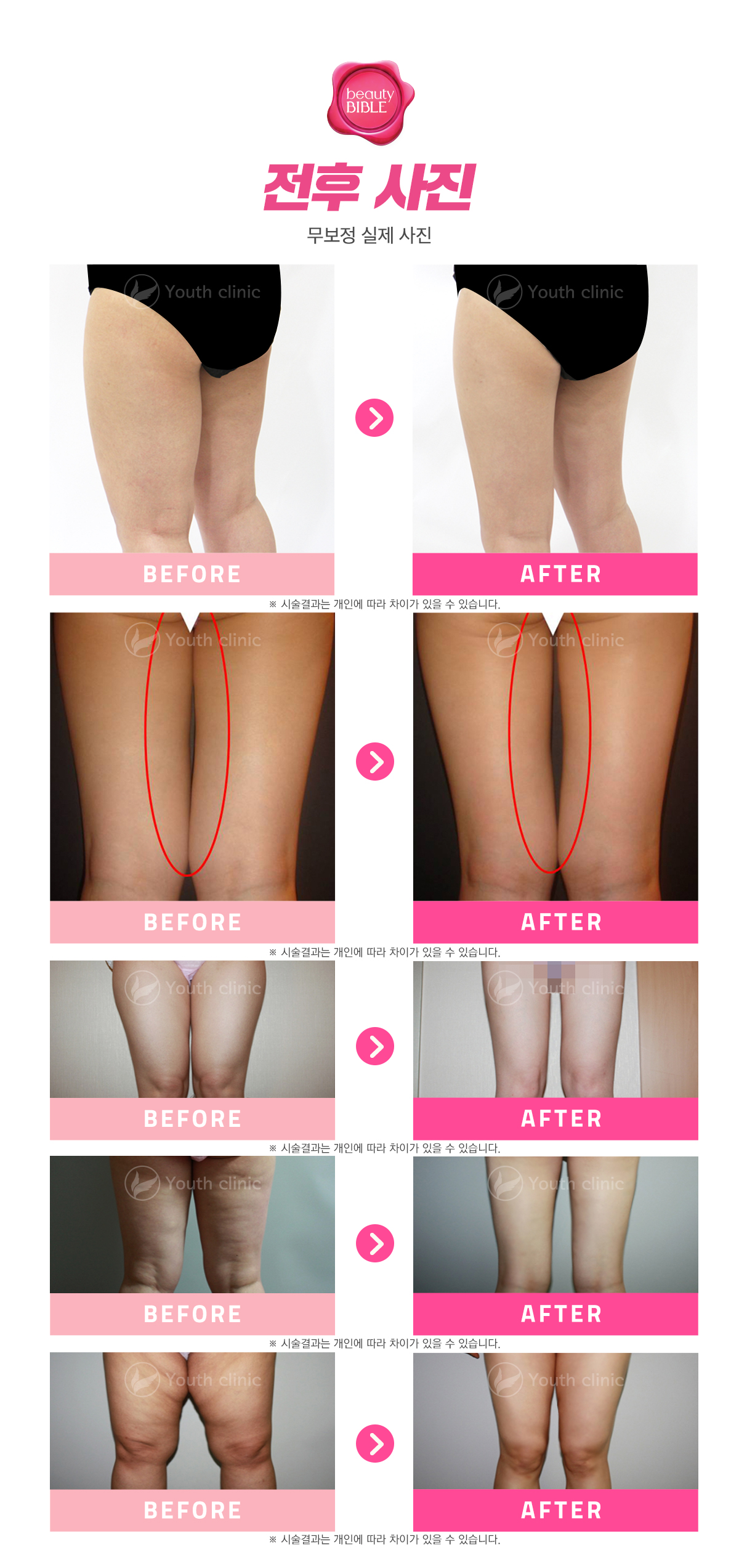 허벅지 전후 사진