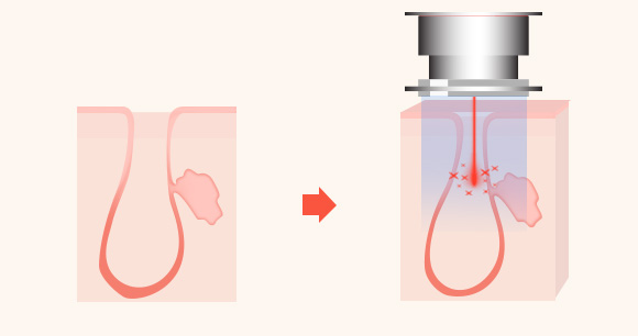 모공 확장/콜라겐층 자극