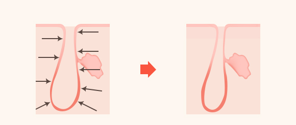 모공 축소 및 탄력 개선/개선된 상태 유지