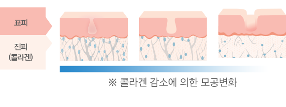콜라겐 감소에 의한 모공 변화